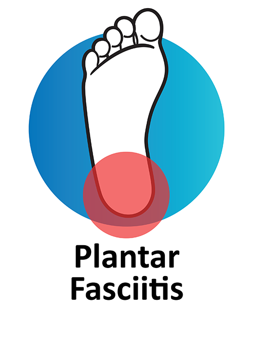 Plantar Fasciitis