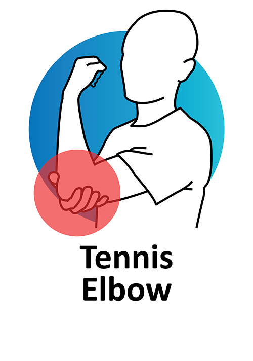 Tennis Elbow