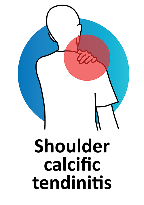 Shoulder calcific tendinitis